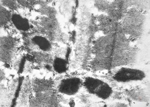 F,56y. | nemaline myopathy v.s. F,56y. | nemaline myopathy v.s.